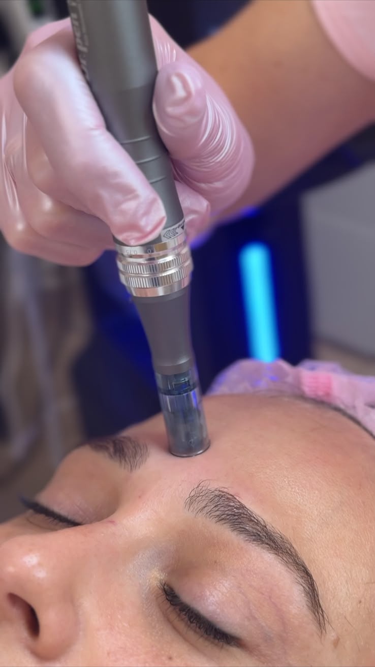 Microneedling während der Behandlung